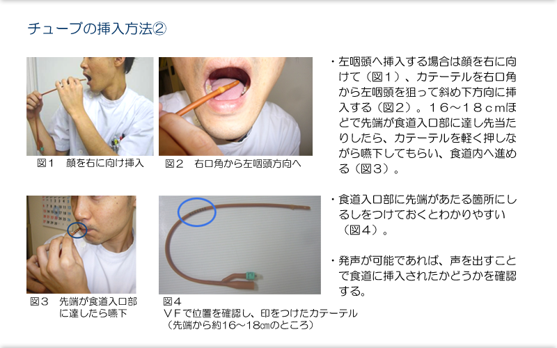 48.咽頭期に対する間接訓練：チューブ嚥下訓練・バルーン拡張法