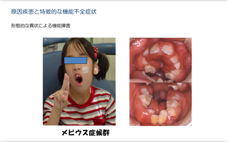ダウン症の子どもの摂食嚥下ハビリテーション ダウン症の子どもの摂食嚥下ハビリテーション | 田村 文誉, 水上