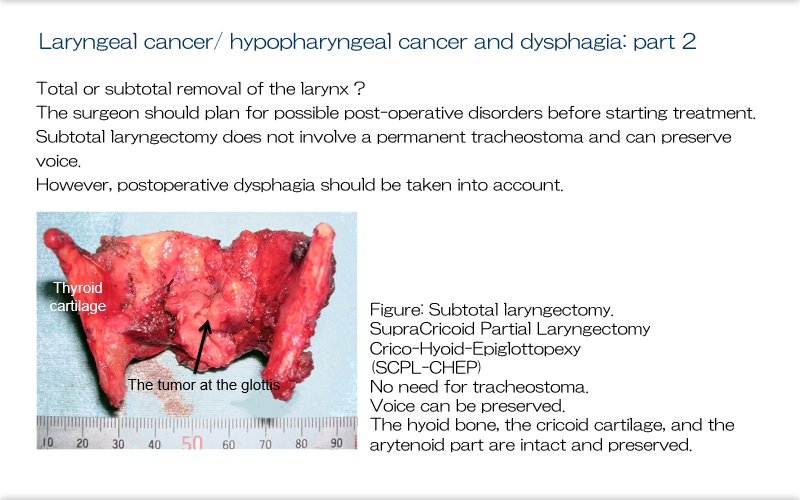 9.Dysphagia in patients with Head and Neck Cancer