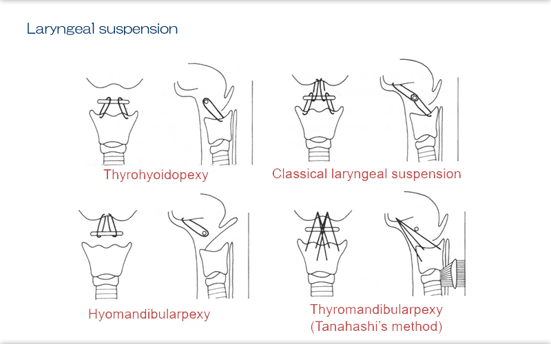 62.Surgeries For Improving Swallowing And Preventing Aspiration